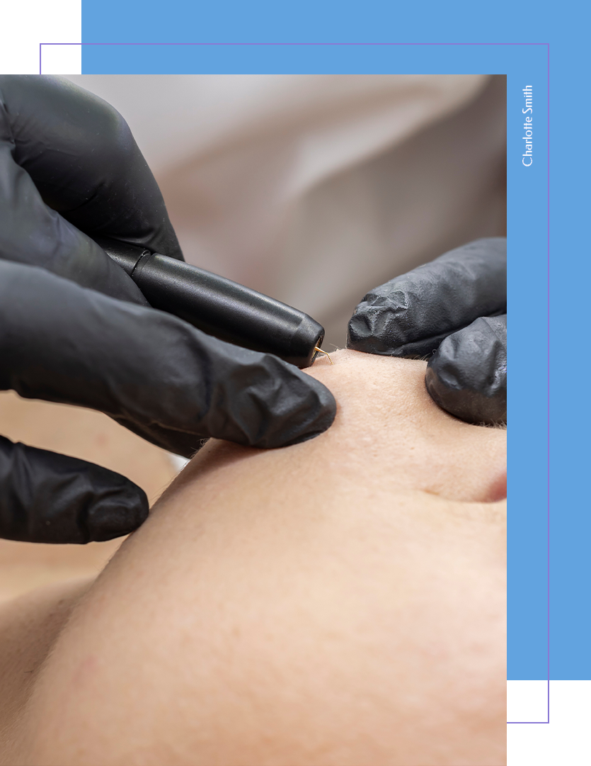 Facial Hair Removal Facial Hair Removal