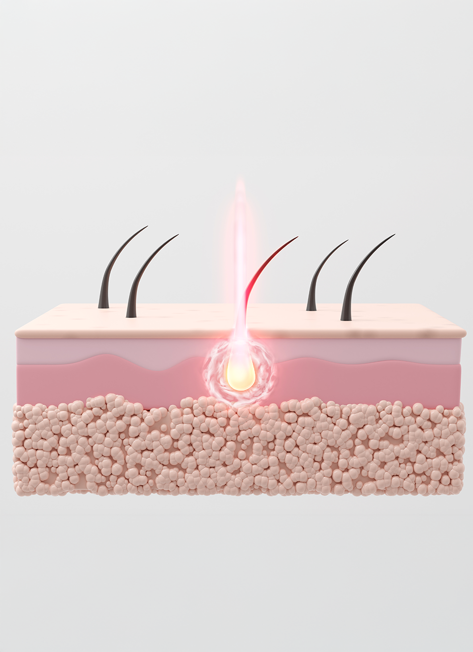 Permanent Hair Removal For Stubborn Hair Permanent Hair Removal For Stubborn Hair